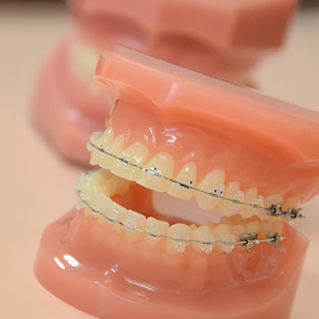 clear braces